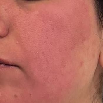 Bioderma Gece Serumu Cildimde Yanma Ve Kızarıklık Yaptı