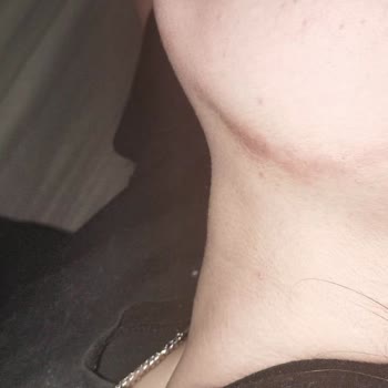 La Roche - Posay Cilt Ürünü Kızımın Cildinde Yaralara Sebep Oldu