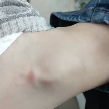 Ayakkabının Bilek Kısmı Yara Yapıyor