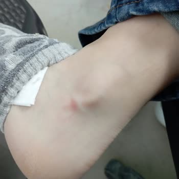 Ayakkabının Bilek Kısmı Yara Yapıyor