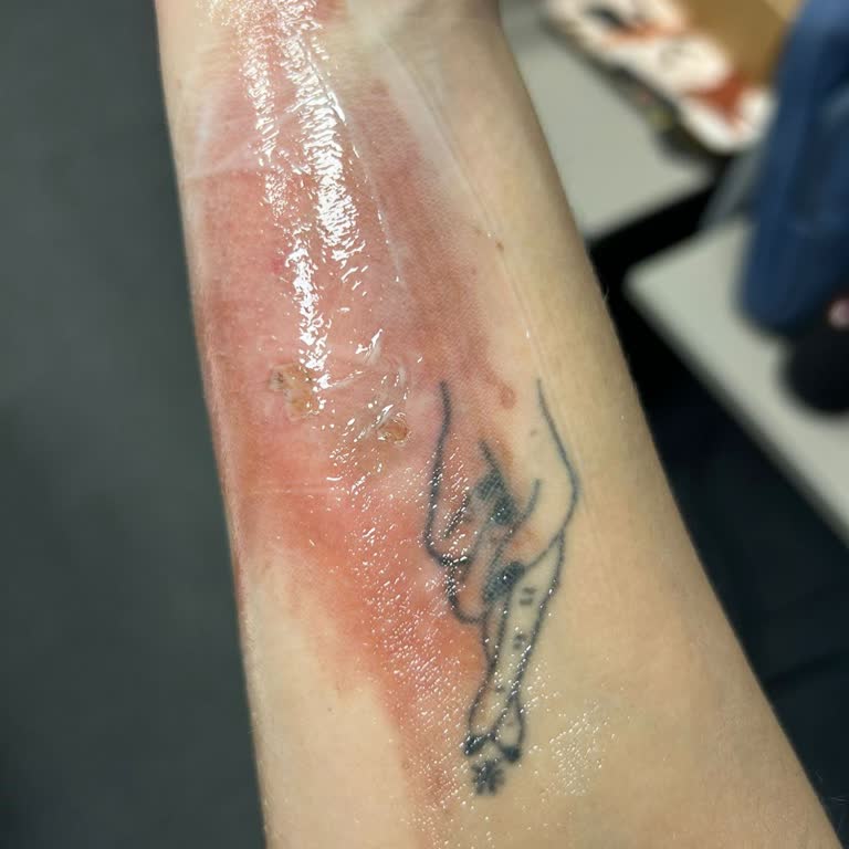 Lavabo Açıcı Kullanımı Sonrası Ciddi Yanık Ve İş Gücü Kaybı