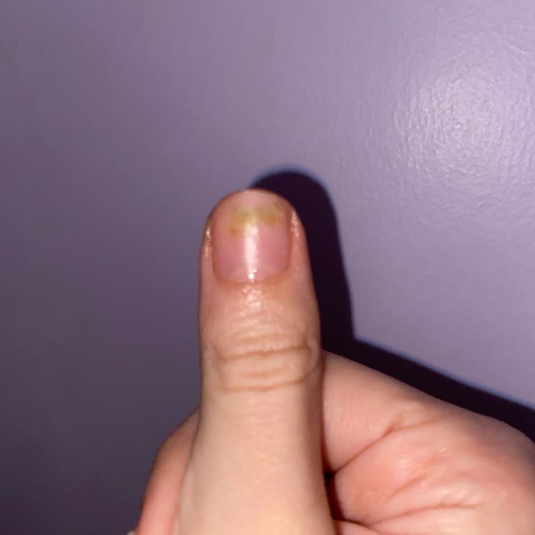 Protez Tırnakta Hijyen Eksikliği Ve Mantar Sorunu