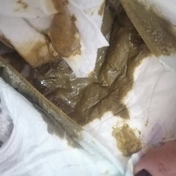 Aptamil Prosyneo: Bebek Sağlığını Tehdit Eden Mama