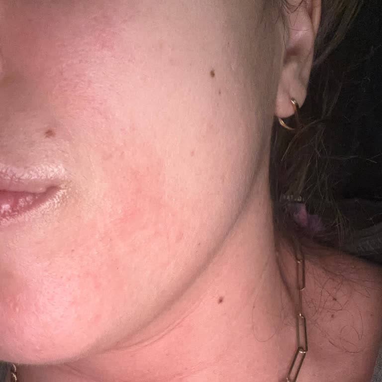 Bioderma Sebium Sensitive Kremi Alerji Ve Kaşıntıya Sebep Oldu