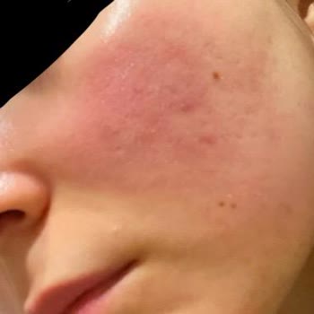 Bioderma Atoderm Baume Kullanımı Sonrası Kızarıklık Ve Yanma Sorunu