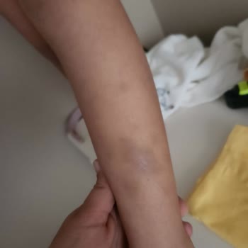 Yanlış Teşhis Ve İhmal Sonucu Lösemi Şoku