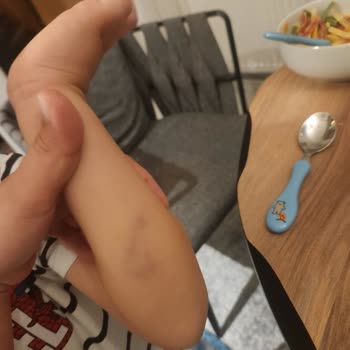 Yanlış Teşhis Ve İhmal Sonucu Lösemi Şoku