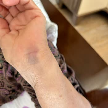 Patlayan Tencere Kapağıyla Gelen Tehlike