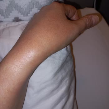 L'Occitane Shea Hand Balm Caused Redness and Burning Sensation