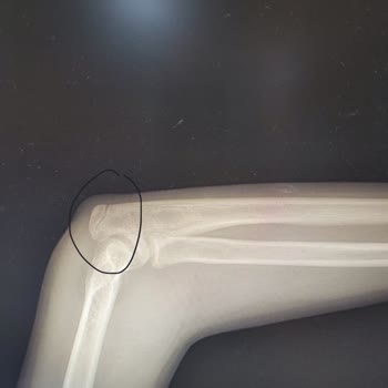 Güvenlik İhmali Sonucu Kızımın Kolu Kırıldı!