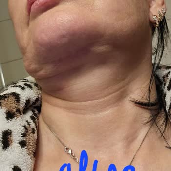 Okan Üniversitesi Hastanesi Başarısız Plastik Cerrahi Ve İletişimsizlik Sorunu