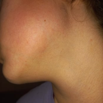 The Purest Solutions Alerjik Ciltte Ürünleri İle Beklenmedik Reaksiyon