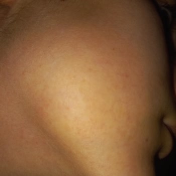 The Purest Solutions Alerjik Ciltte Ürünleri İle Beklenmedik Reaksiyon