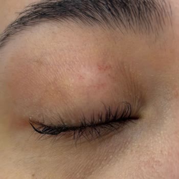 Epilady Sultanbeyli'de Tahriş Ve İlgisizlik Sorunu