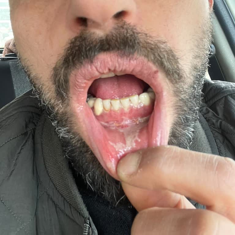 Sensodyne Diş Macunu Kullanımı Sonrası Ağız Yaraları Ve Sağlık Sorunları