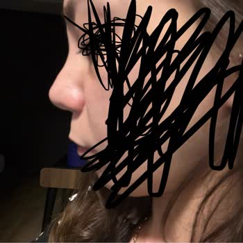 Ameliyat Sonrası Burnumda Kalıcı Hasar Ve İlgisizlik