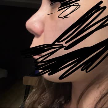 Ameliyat Sonrası Burnumda Kalıcı Hasar Ve İlgisizlik