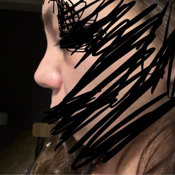 Ameliyat Sonrası Burnumda Kalıcı Hasar Ve İlgisizlik