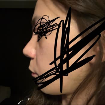 Ameliyat Sonrası Burnumda Kalıcı Hasar Ve İlgisizlik