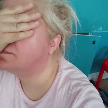 Cilt Serumu Alerjik Reaksiyona Sebep Oldu