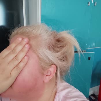 Cilt Serumu Alerjik Reaksiyona Sebep Oldu