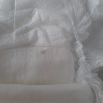 Bebek Bezinde Beklenmedik Sorun