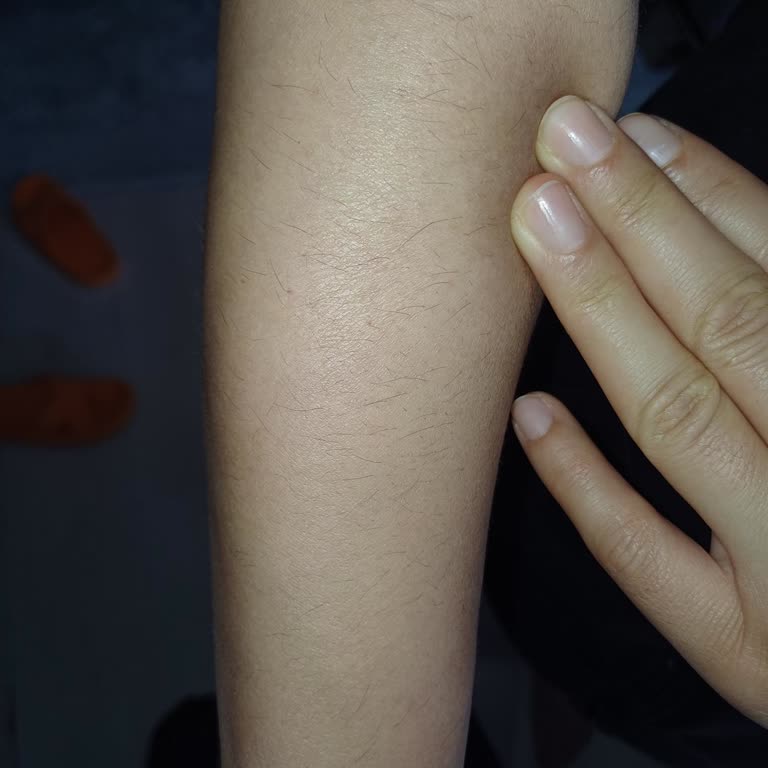 Etkisiz Lazer Epilasyon Deneyimi