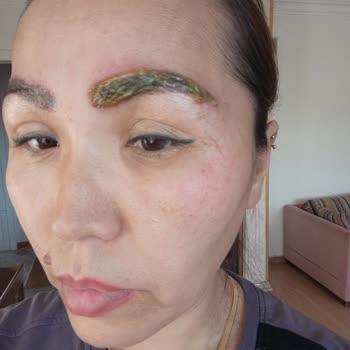 Yanlış Uygulama Sonucu Yaşanan Sağlık Sorunu