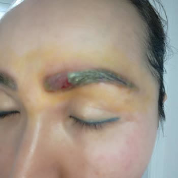 Yanlış Uygulama Sonucu Yaşanan Sağlık Sorunu