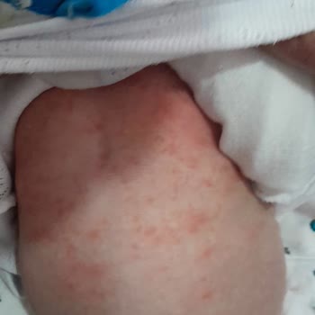 Bebek Şampuanı Alerjiye Sebep Oldu