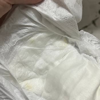 Bebek Bezi Kalitesizliği Ve Cilt Sorunları