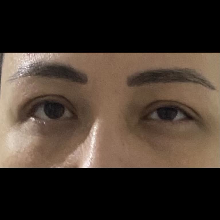 Ameliyat Sonrası Görme Sorunları Ve İletişim Eksikliği