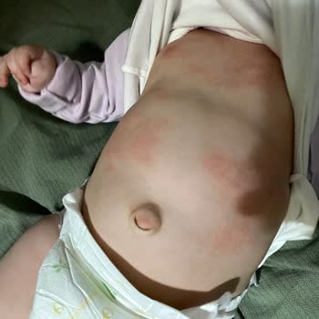 Mustela Ürünleri Bebeğimin Cildini Kızarttı