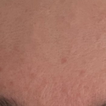 Bioderma Atoderm Ürünleri Cildimde Komedonlara Sebep Oldu