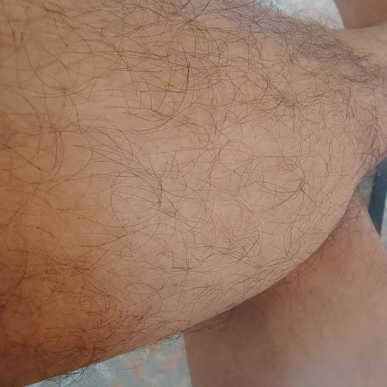 Yanlış Tedavi Sonucu Artan Kıllar Ve İade Sorunu