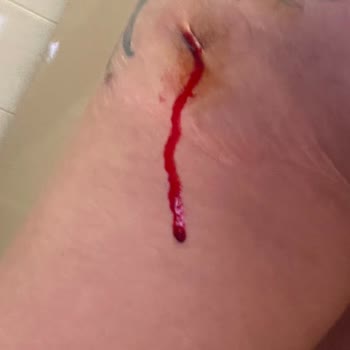 Estetik Operasyon Sonrası Hayal Kırıklığı Ve Sağlık Sorunları