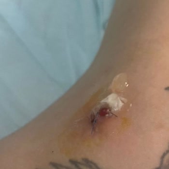 Estetik Operasyon Sonrası Hayal Kırıklığı Ve Sağlık Sorunları