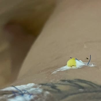 Estetik Operasyon Sonrası Hayal Kırıklığı Ve Sağlık Sorunları