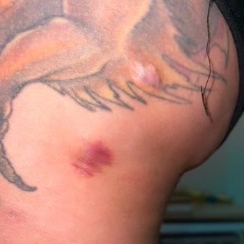 Başarısız Dolgu İşlemi Ve Kapanmayan Dikişler