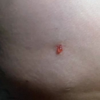 Başarısız Dolgu İşlemi Ve Kapanmayan Dikişler