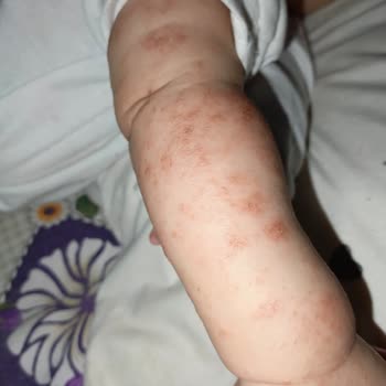 Bebeğimin Uyuz Sorununa Çözüm Arayışı