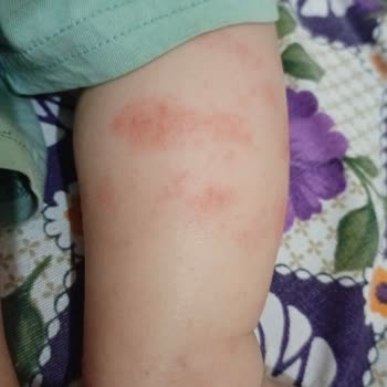 Bebeğimin Uyuz Sorununa Çözüm Arayışı