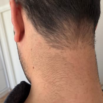 Novar Poliklinikte Epilasyon Hayal Kırıklığı