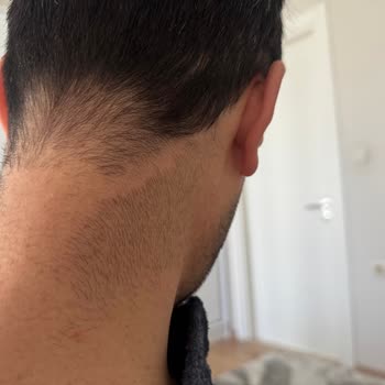 Novar Poliklinikte Epilasyon Hayal Kırıklığı