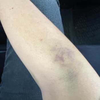 Özel Hastanede Damar Yolu Açma Sorunu Ve İlgisizlik