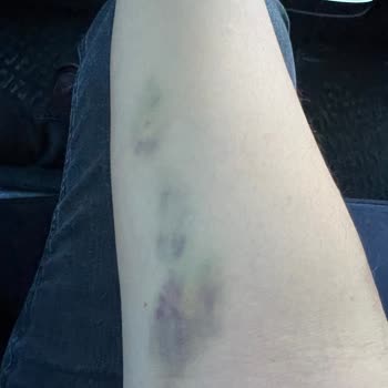 Özel Hastanede Damar Yolu Açma Sorunu Ve İlgisizlik