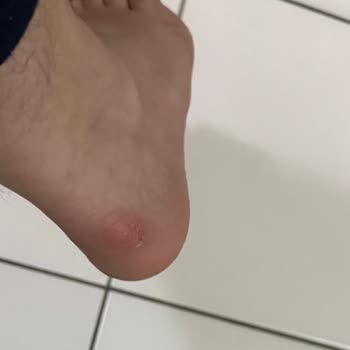 Sert Ayakkabı Arkası Nedeniyle Yaşanan Rahatsızlık