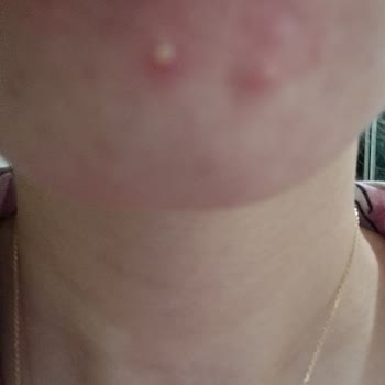 Cilt Bakımı Sonrası Sorunlar Ve İletişim Problemleri