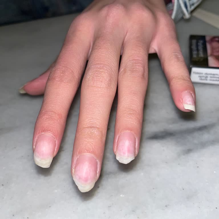 Gratis Beauty Tırnak Çıkartma İşleminde Hayal Kırıklığı