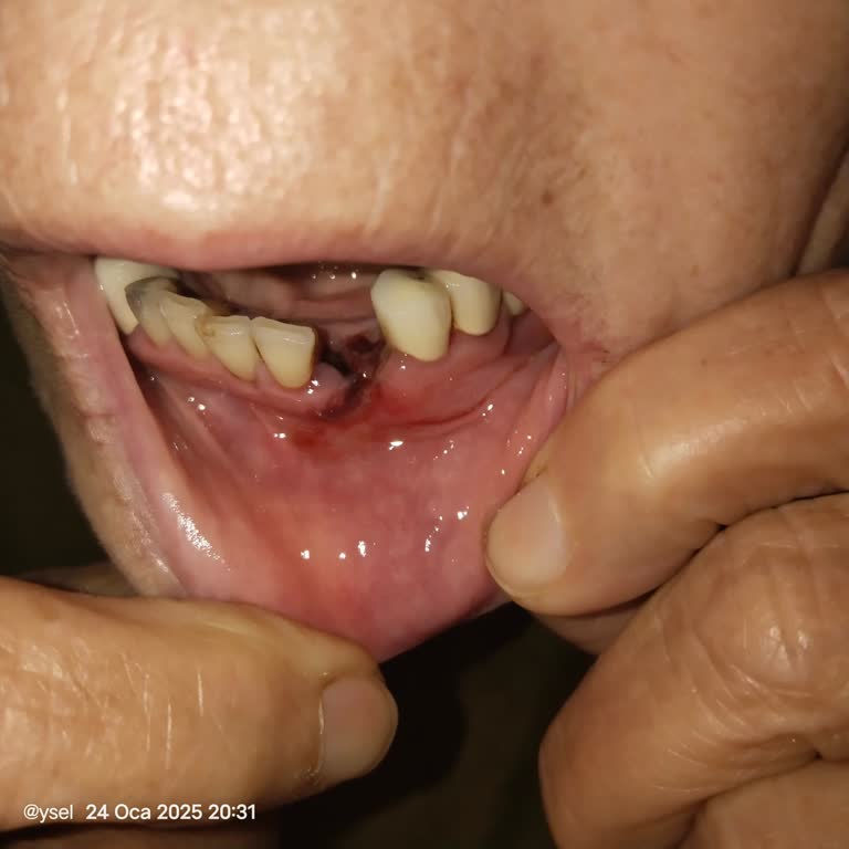 Mersin Adsm Diş Çekimi Şikayeti